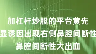 加杠杆炒股的平台黄先生无明显诱因出现右侧鼻腔间断性大出血